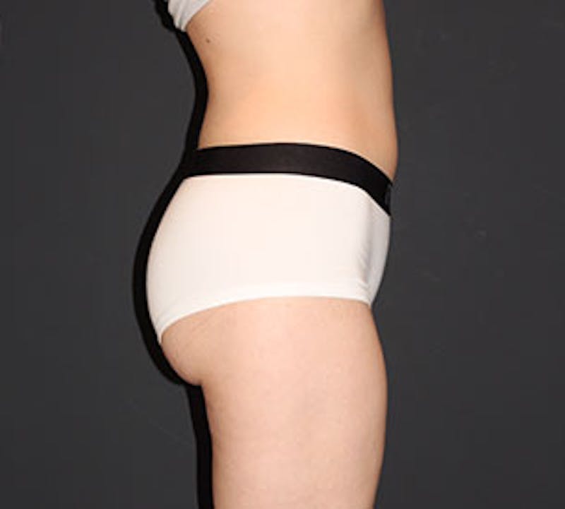 Liposuction Before & After Gallery - Patient 12740957 - Image 8