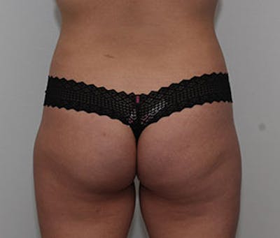 Brazilian Butt Lift Before & After Gallery - Patient 12740965 - Image 1