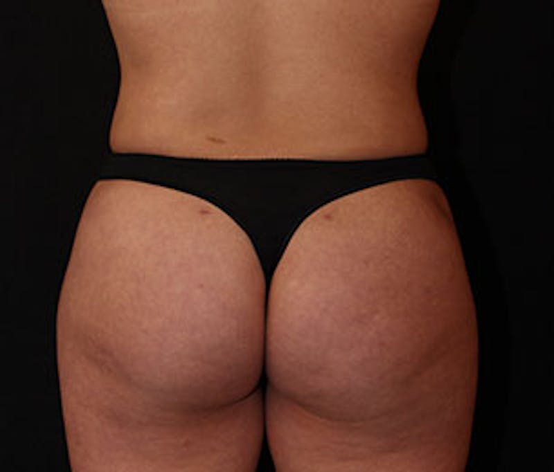 Brazilian Butt Lift Before & After Gallery - Patient 12740965 - Image 2