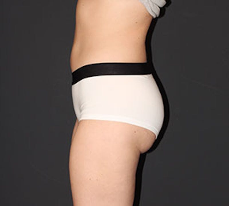 Liposuction Before & After Gallery - Patient 12740957 - Image 10