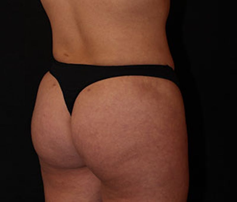 Brazilian Butt Lift Before & After Gallery - Patient 12740965 - Image 4