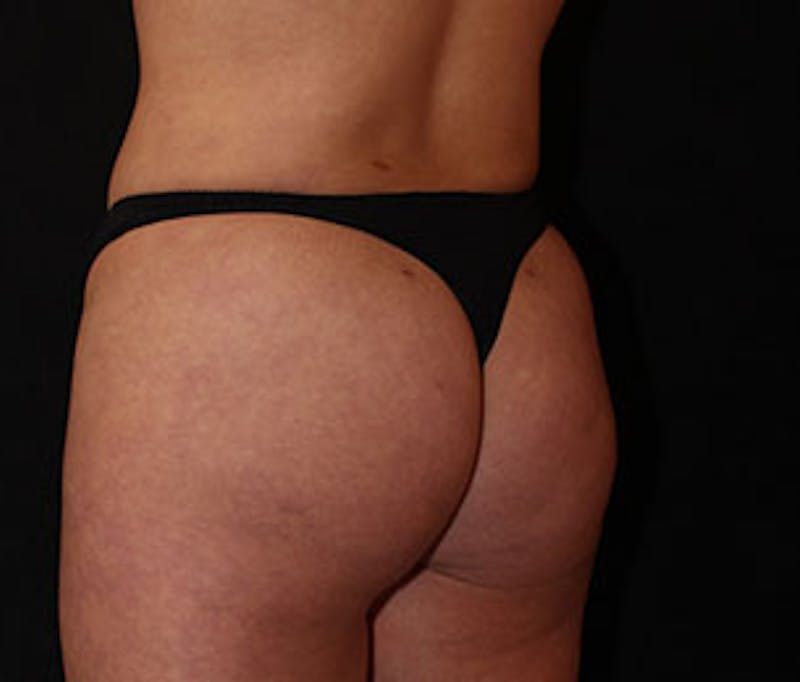 Brazilian Butt Lift Before & After Gallery - Patient 12740965 - Image 8