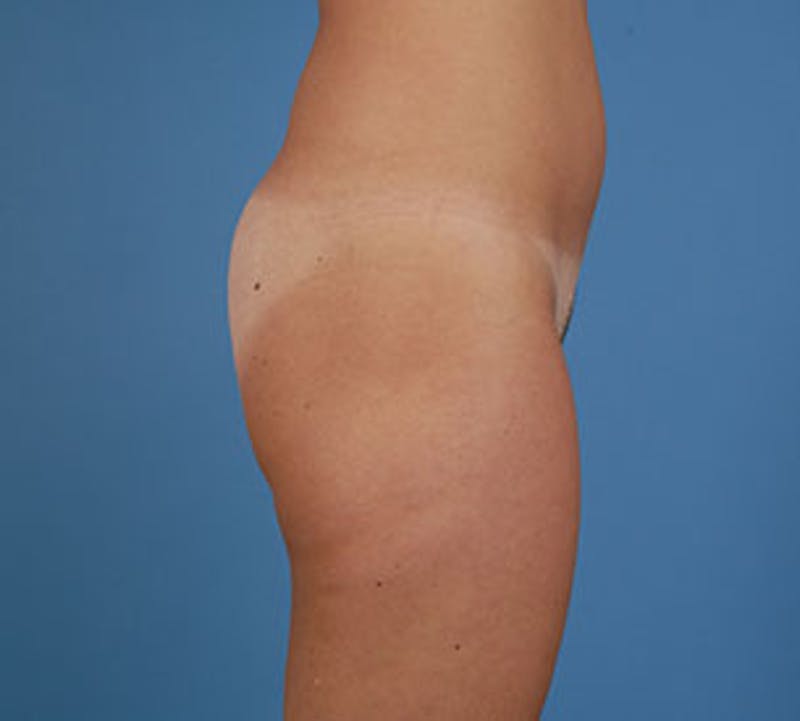 Liposuction Before & After Gallery - Patient 12740966 - Image 3