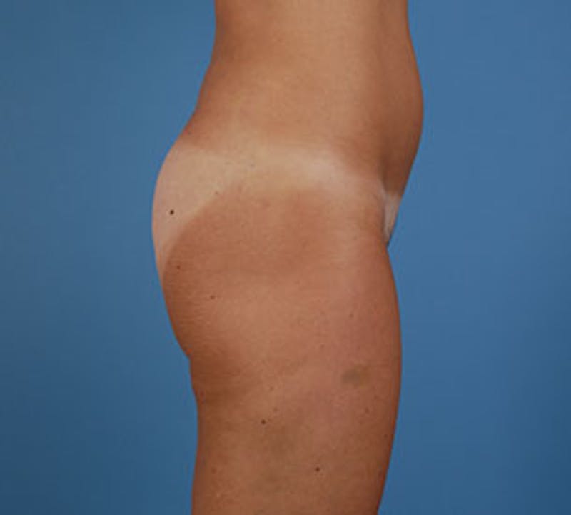Liposuction Before & After Gallery - Patient 12740966 - Image 4