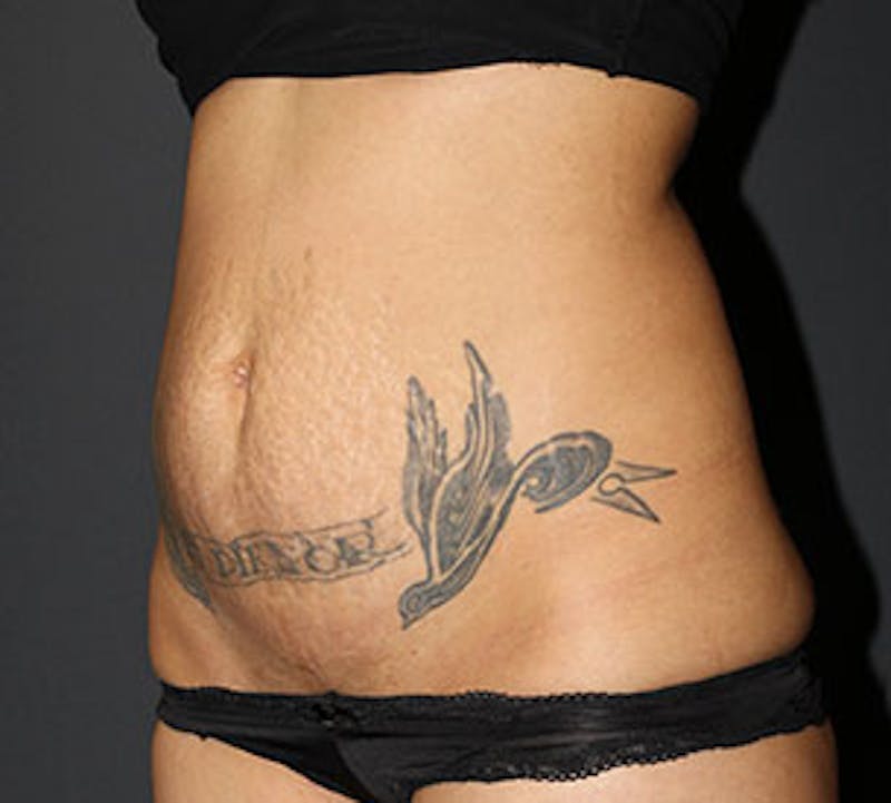 Tummy Tuck Before & After Gallery - Patient 12740964 - Image 7