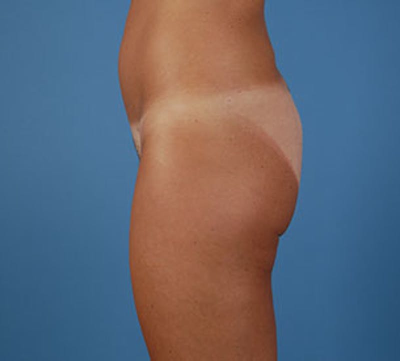 Liposuction Before & After Gallery - Patient 12740966 - Image 6