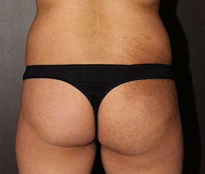 Brazilian Butt Lift Before & After Gallery - Patient 12740968 - Image 1