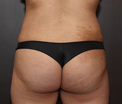 Brazilian Butt Lift Before & After Gallery - Patient 12740968 - Image 2