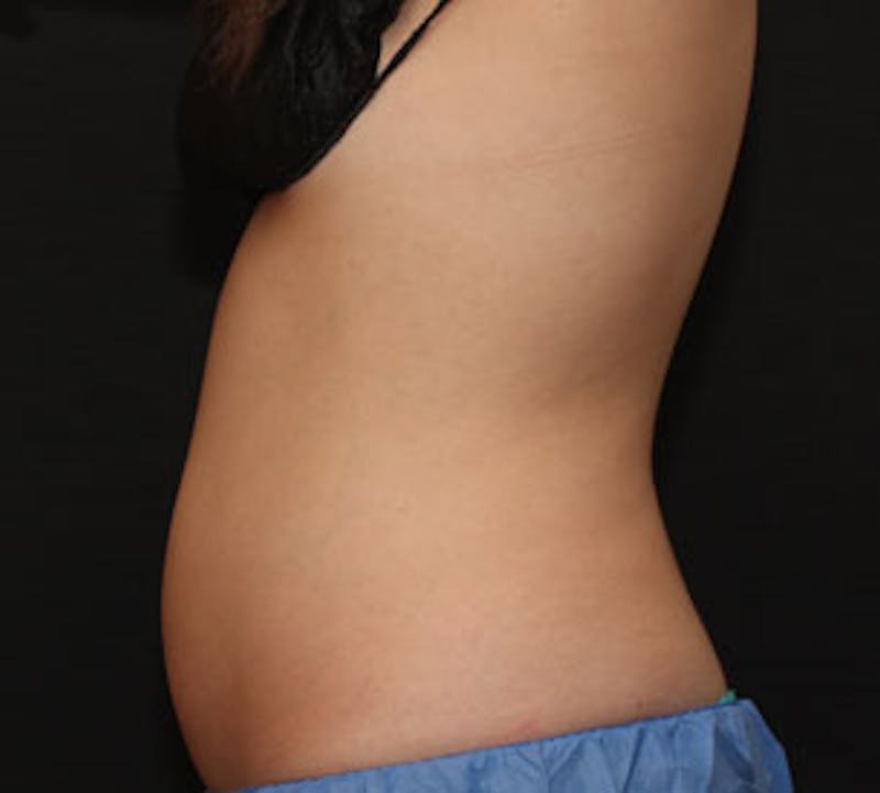 CoolSculpting Before & After Gallery - Patient 12740969 - Image 1