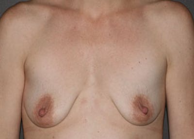 妈妈Makeover Before & After Gallery - Patient 12742209 - Image 1