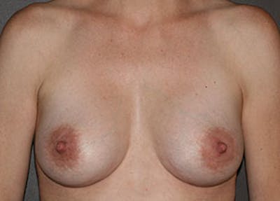 妈妈Makeover Before & After Gallery - Patient 12742209 - Image 2