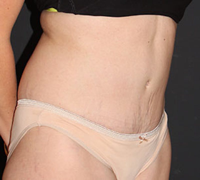 Tummy Tuck Gallery - Patient 12742208 - Image 4