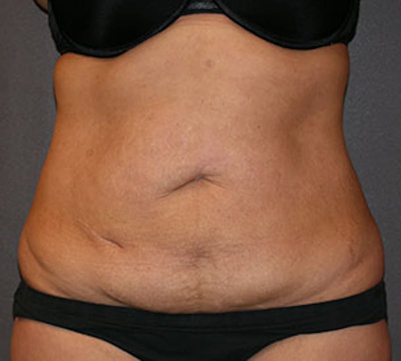 Tummy Tuck Before & After Gallery - Patient 12742216 - Image 1