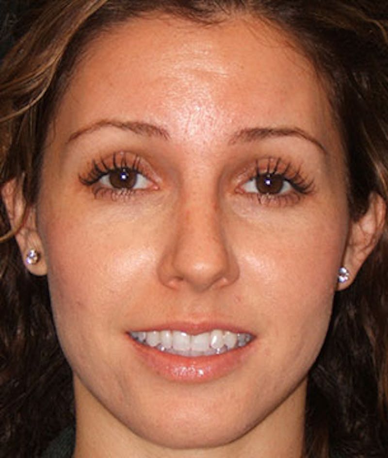 Botox Before & After Gallery - Patient 12742214 - Image 5