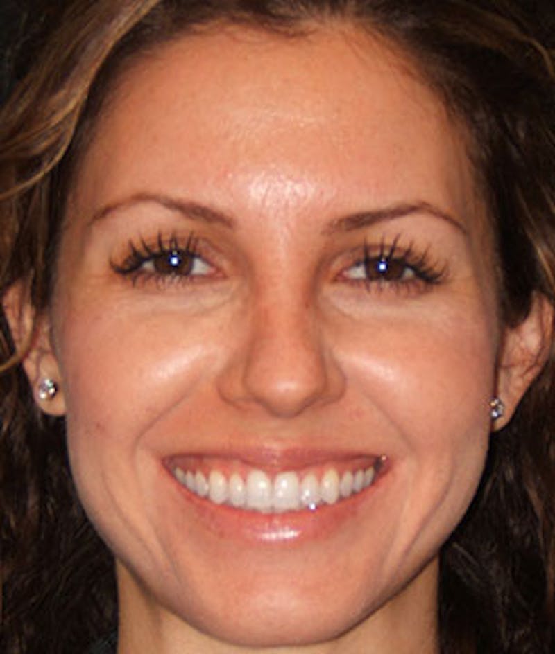 Botox Before & After Gallery - Patient 12742214 - Image 7