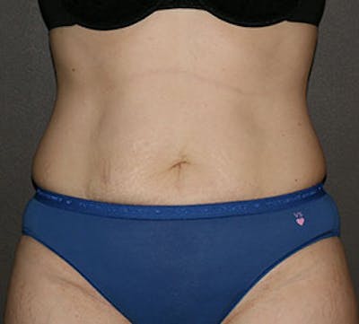 Tummy Tuck Before & After Gallery - Patient 12742221 - Image 1