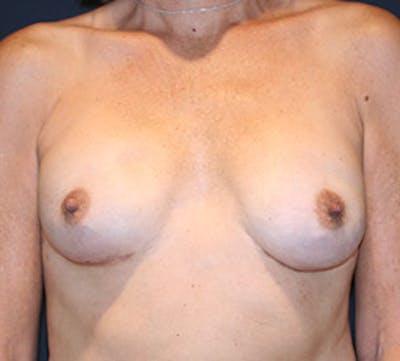 乳房重建前后画廊-患者12742222 -图像2