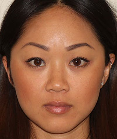 Botox Before & After Gallery - Patient 12742230 - Image 2