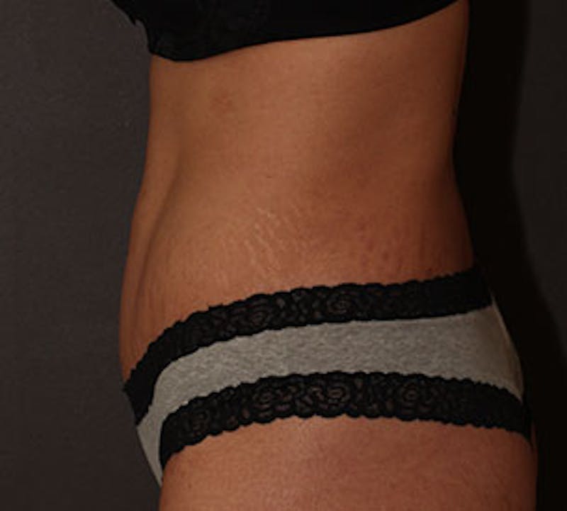 Tummy Tuck Before & After Gallery - Patient 12742232 - Image 8
