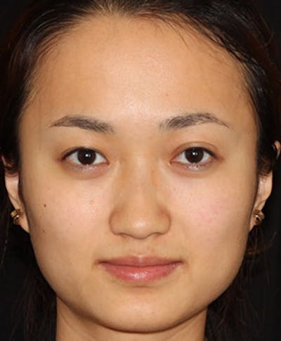 Botox Before & After Gallery - Patient 12742243 - Image 2