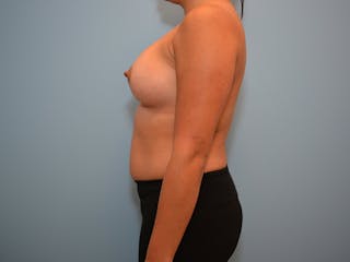 Breast Augmentation Before & After Gallery - Patient 12767665 - Image 6