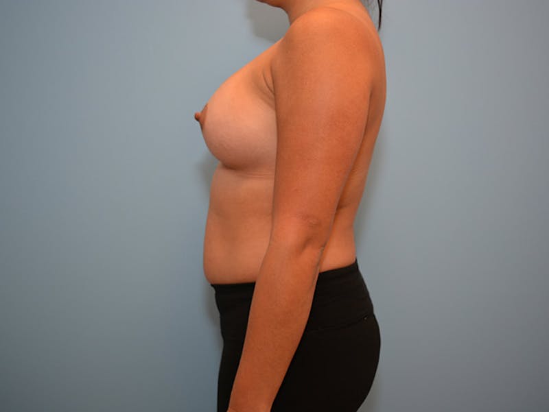 Breast Augmentation Before & After Gallery - Patient 12767665 - Image 6