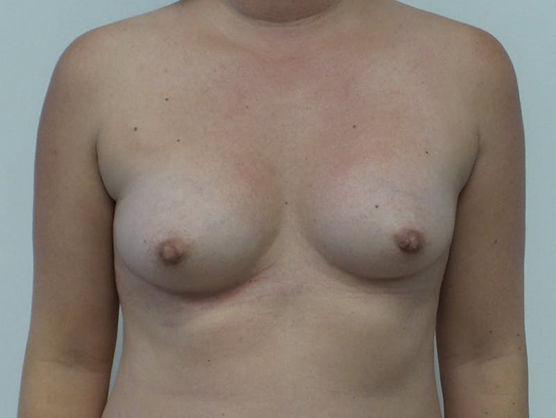 Breast Augmentation Before & After Gallery - Patient 12767666 - Image 1