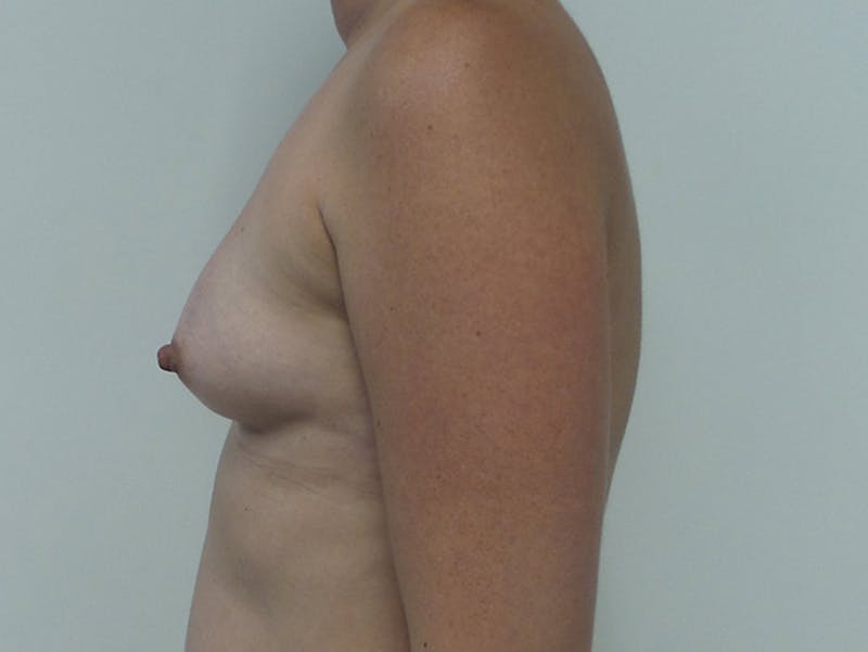 Breast Augmentation Before & After Gallery - Patient 12767666 - Image 5