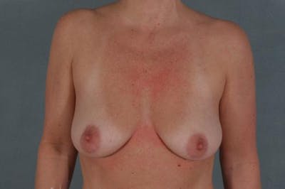Breast Augmentation Before & After Gallery - Patient 12767671 - Image 1