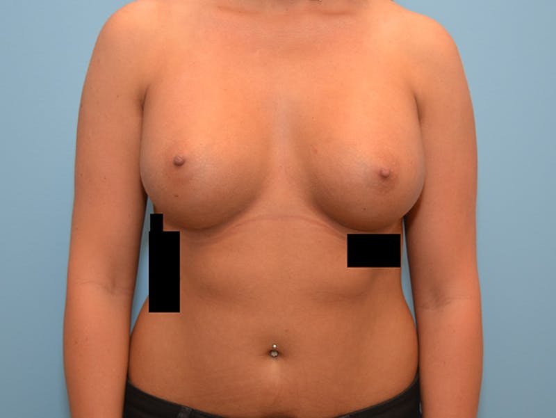 Breast Augmentation Gallery - Patient 12786204 - Image 2