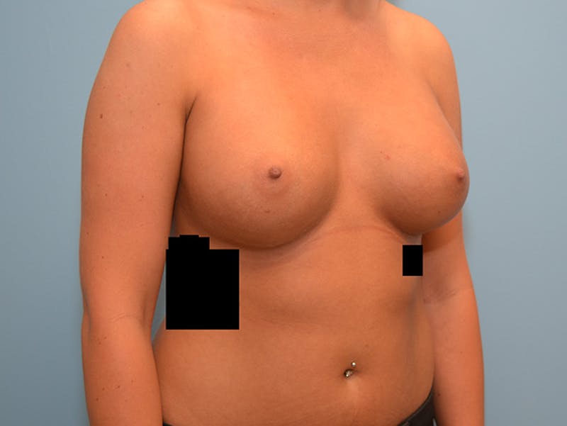 Breast Augmentation Before & After Gallery - Patient 12786204 - Image 4