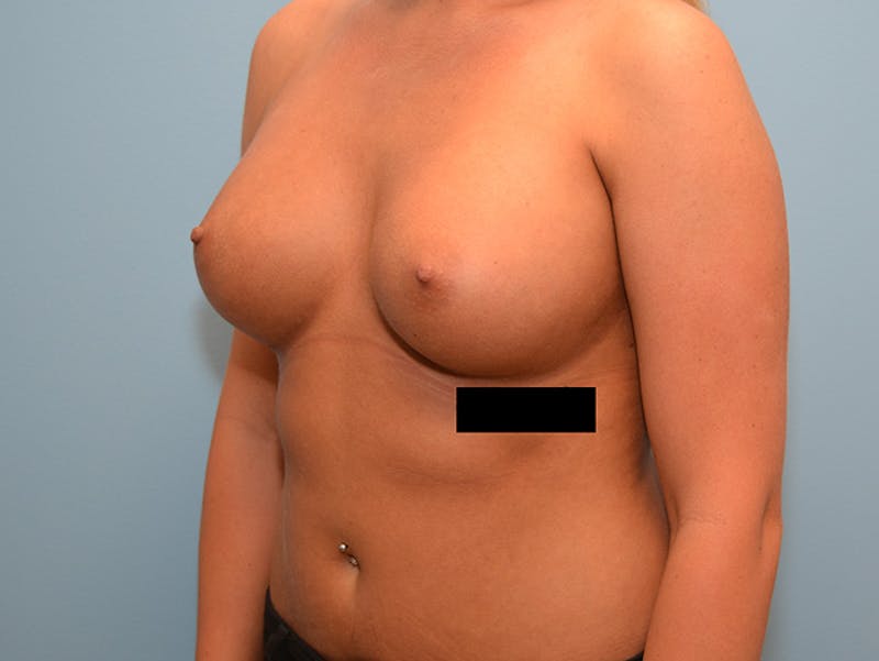 Breast Augmentation Before & After Gallery - Patient 12786204 - Image 6