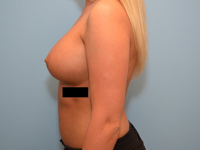 Breast Augmentation Before & After Gallery - Patient 12786204 - Image 10