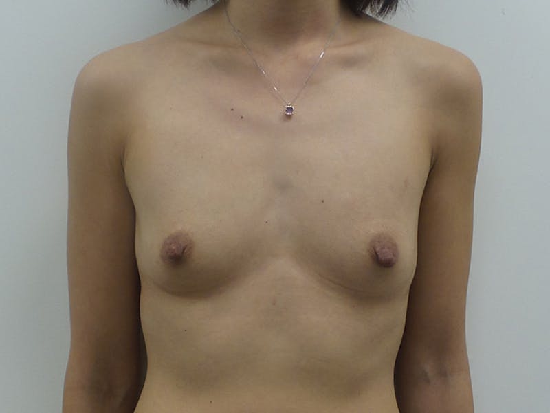 Breast Augmentation Before & After Gallery - Patient 12793887 - Image 1