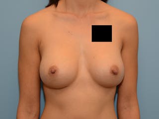 Breast Augmentation Before & After Gallery - Patient 12793887 - Image 2
