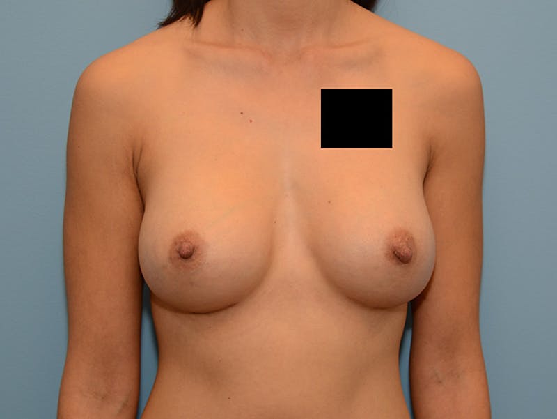 Breast Augmentation Before & After Gallery - Patient 12793887 - Image 2
