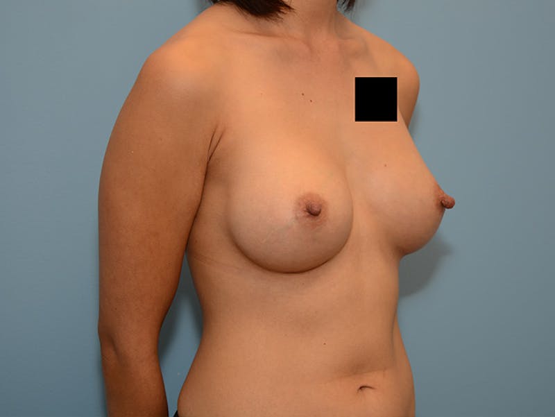 Breast Augmentation Before & After Gallery - Patient 12793887 - Image 4