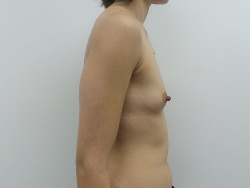 Breast Augmentation Before & After Gallery - Patient 12793887 - Image 5