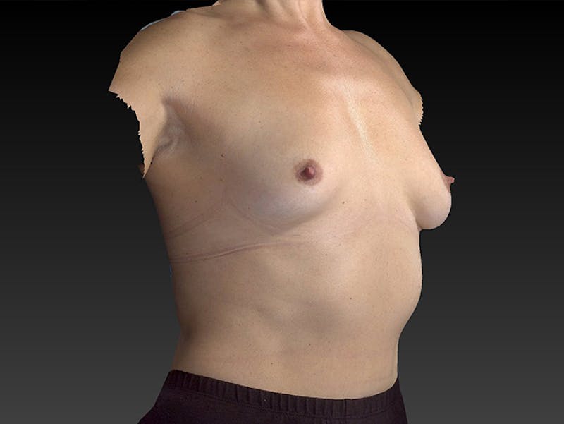 Breast Augmentation Before & After Gallery - Patient 12812398 - Image 5