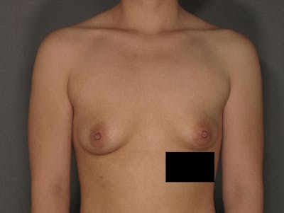 Breast Augmentation Before & After Gallery - Patient 12812401 - Image 1
