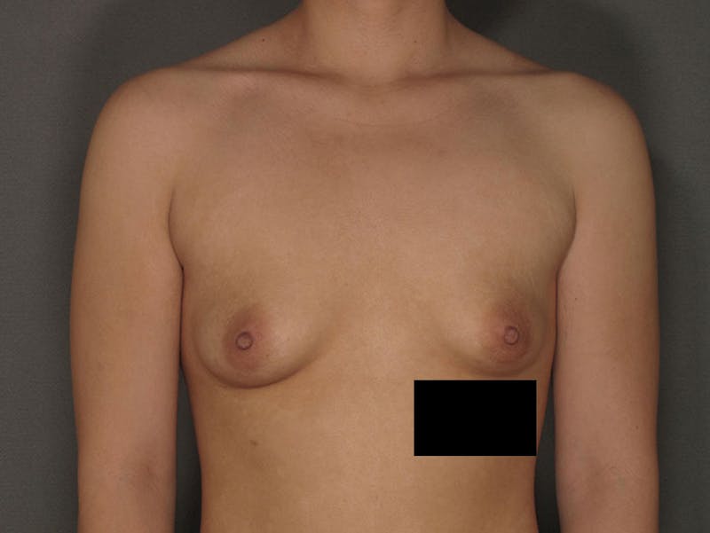 Breast Augmentation Before & After Gallery - Patient 12812401 - Image 1