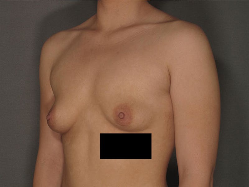 Breast Augmentation Before & After Gallery - Patient 12812401 - Image 3