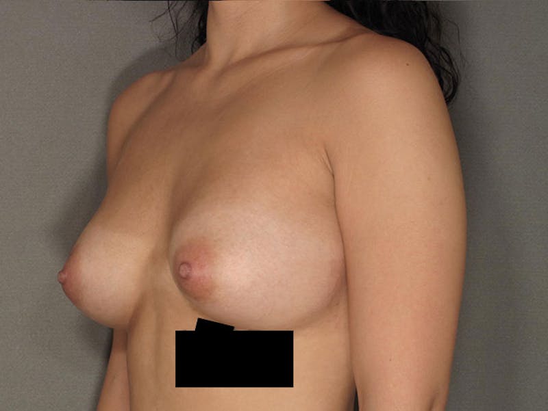 Breast Augmentation Before & After Gallery - Patient 12812401 - Image 4