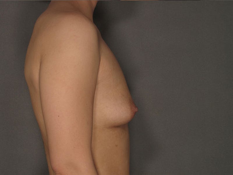 Breast Augmentation Before & After Gallery - Patient 12812401 - Image 9
