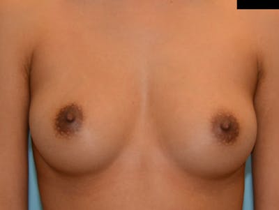 Breast Augmentation Before & After Gallery - Patient 12812402 - Image 1