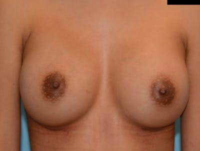 Breast Augmentation Before & After Gallery - Patient 12812402 - Image 2