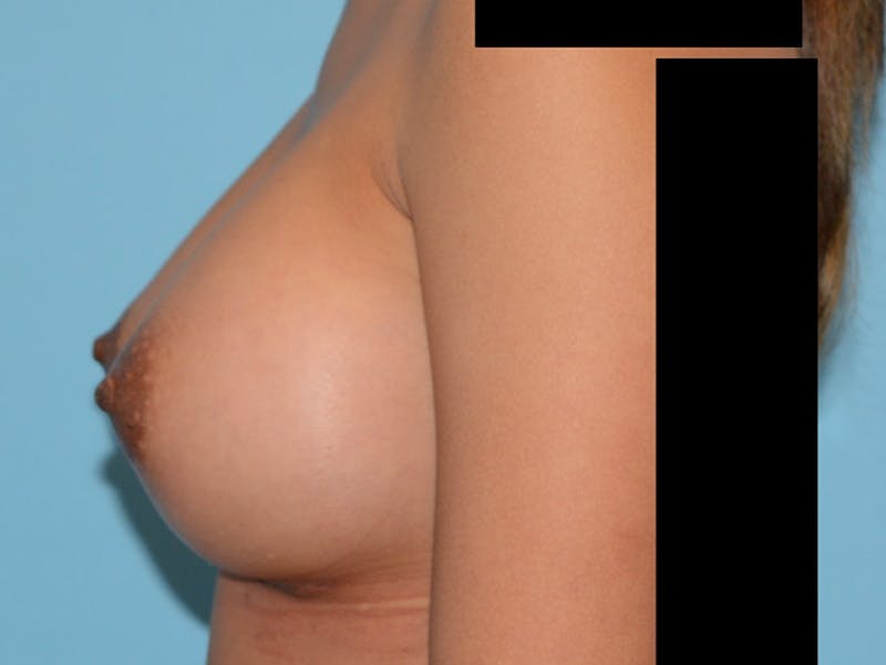 Breast Augmentation Before & After Gallery - Patient 12812402 - Image 6