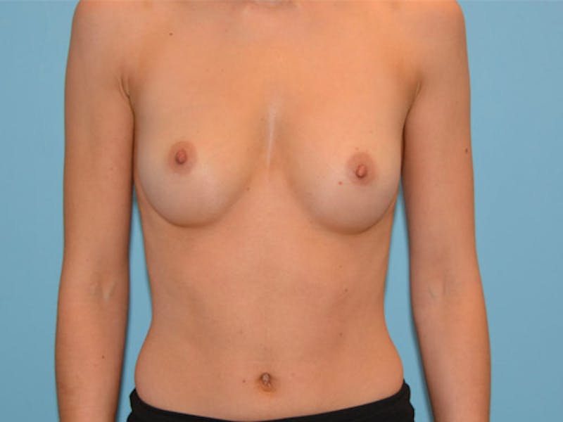 Breast Augmentation Before & After Gallery - Patient 12812406 - Image 1