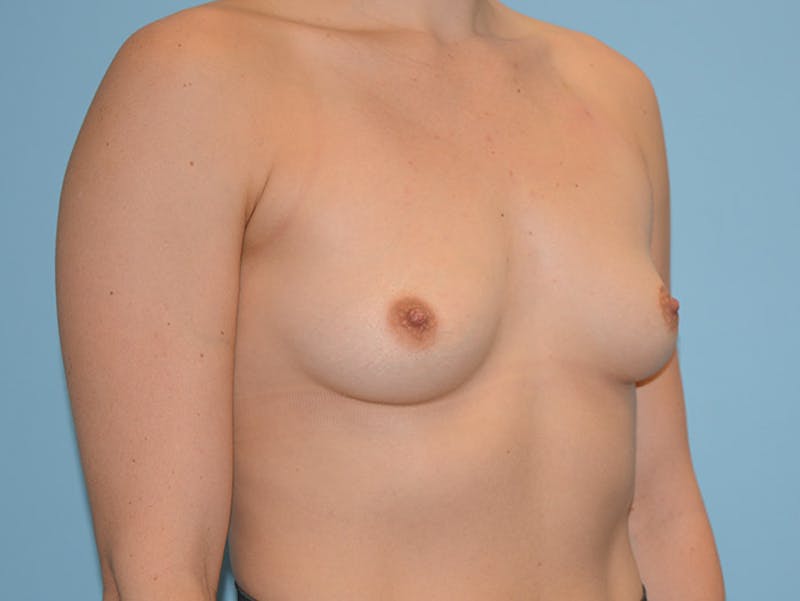 Breast Augmentation Before & After Gallery - Patient 12820076 - Image 3