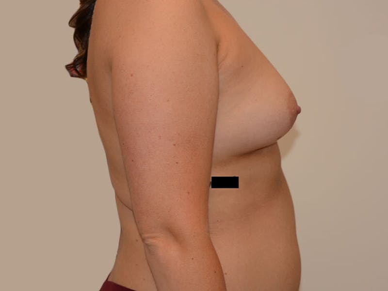 Breast Augmentation Before & After Gallery - Patient 12820080 - Image 3
